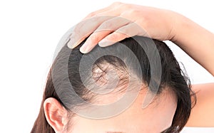 Una mujer grave cabello pérdida cuidado champú a elegante 