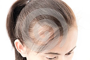 Una mujer grave cabello pérdida cuidado champú a elegante 