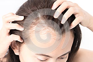 Woman serious hair loss problem for health care shampoo and beau photo