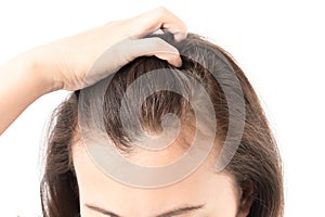 Woman serious hair loss problem for health care shampoo and beau