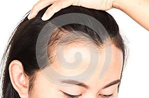 Woman serious hair loss problem for health care shampoo and beau