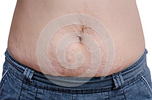 Woman showing her stretch marks