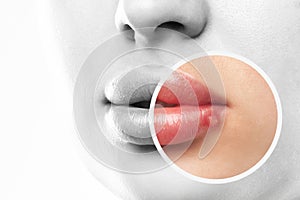 Woman showing herpes disease on her lips. Treatment of viral infections