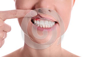 Woman showing inflamed gums on white background, closeup view