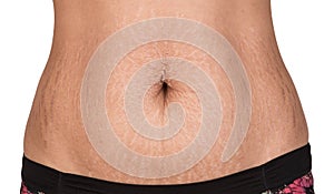 Woman showing stretch marks. photo