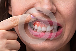 Woman Showing Swelling Of Her Gum