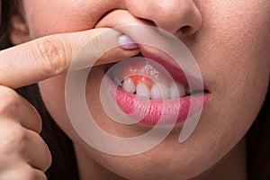 Woman Showing Swelling Of Her Gum