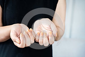 woman showing yellow nail fungus caused by wearing nail polish