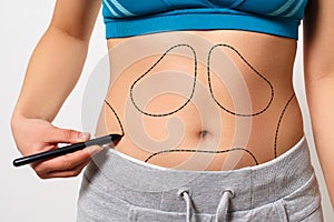 A woman shows a dotted line on her body liposuction zone