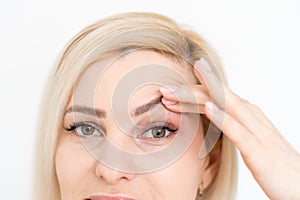 woman shows drooping eyelid for plastic surgery