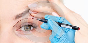 woman shows drooping eyelid for plastic surgery. Doctor plastic surgeon marks with a felt-tip pen a marker for a photo