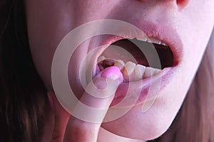 Woman shows pink tooth with caries and cured with use resorcinol-formalin paste.