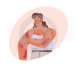 Woman with skin diseases. Vector illustration in flat style on white.