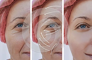 Woman skin face wrinkles correction before and after procedures, arrow