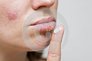 Woman smears her sores on lips with ointment from herpes infection, closeup. Manifestation of the herpes virus on the female lips