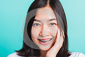 Woman smile have dental braces on teeth laughing she touching her face by hand