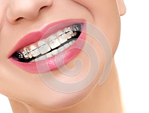Woman Smile with Orthodontic Clear Braces on Teeth.