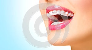 Woman smiling with ceramic braces on teeth