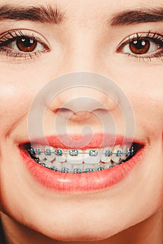 Woman smiling showing teeth with braces