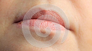 Woman with sores from herpes on her lips, herpes. lip treatment, slow-motion shooting, copy space