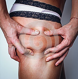 woman squeezes a skin on a hip for check on a cellulitis - p photo