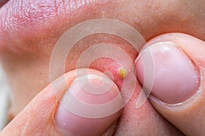 Woman squeezing pimple with two fingers on her face photo