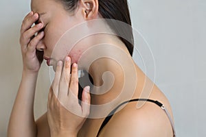 Woman stressed from face acne