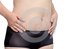 Woman with stretchmarks on her belly photo