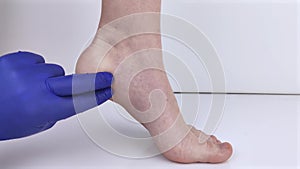 Woman suffering from heel pain. Inflammation or sprain of the tendon in the foot, heel spur, bursitis. The concept of diseases and