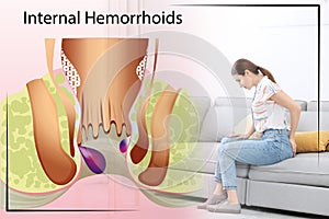 Woman suffering from hemorrhoid pain on sofa at home. Illustration of unhealthy lower rectum