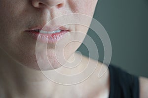 Woman suffers from a very dry lips
