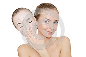 Woman takes away mask with acne and pimples,white background