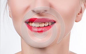 Woman teeth before bleaching.Teeth whitening at the dentist.