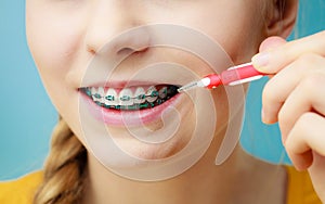 Woman with teeth braces using interdental brush