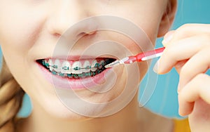 Woman with teeth braces using interdental brush