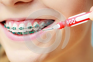 Woman with teeth braces using interdental brush