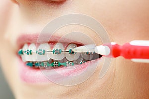 Woman with teeth braces using interdental brush