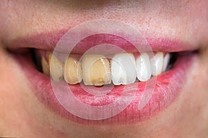 Woman teeth before and after dental treatment