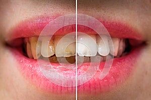 Woman teeth before and after dental treatment