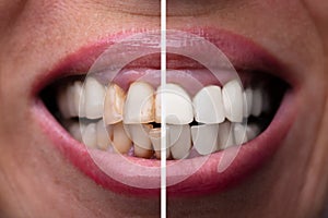 Woman Teeth Before And After Dental Treatment