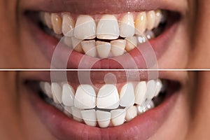 Woman Teeth Before And After Whitening