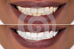 Woman Teeth Before And After Whitening