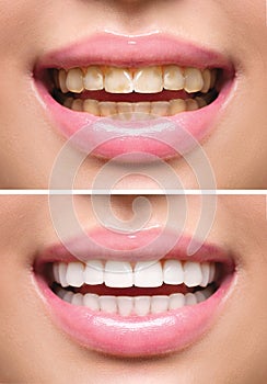 Woman teeth before and after whitening