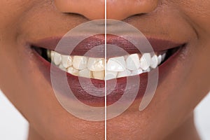 Woman Teeth Before And After Whitening photo
