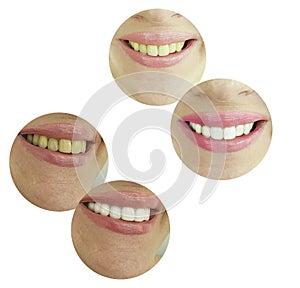 Woman teeth before and after whitening