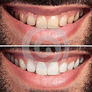 Woman Teeth Before and After Whitening. Happy smiling woman. Dental health Concept. Oral Care