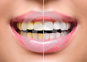 Woman teeth before and after whitening photo