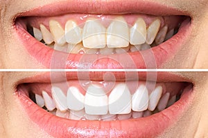 Woman teeth before and after whitening. Over white background