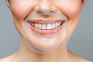 woman teeth before and after whitening. Over white background. Dental clinic patient. Image symbolizes oral care