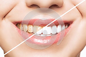 Woman teeth before and after whitening. Over white background. Dental clinic patient. Image symbolizes oral care